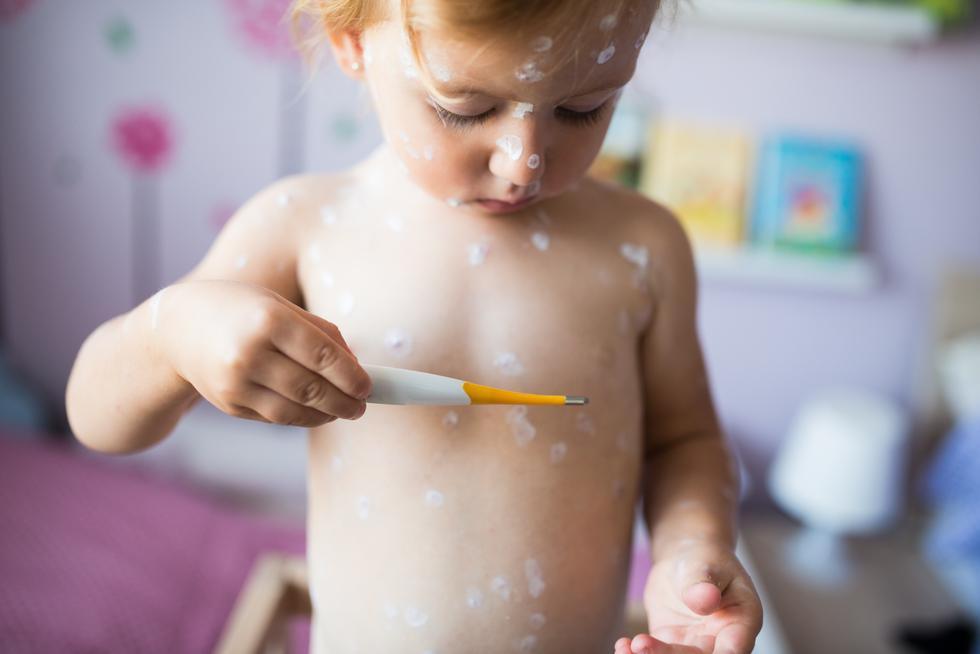 Vattkoppor och bältros - Så hänger det ihop