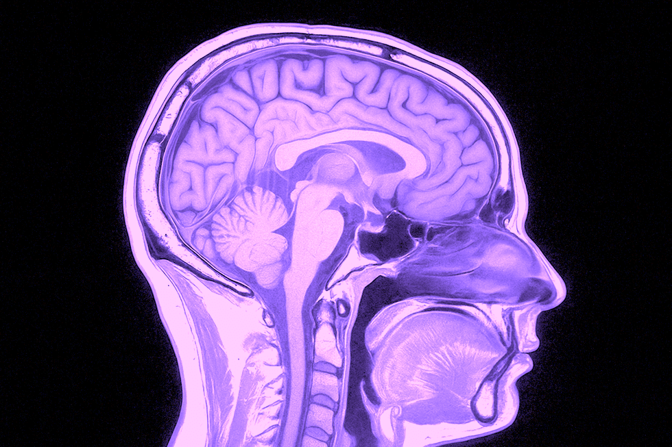 Vad visar en MR-undersökning av hjärnan?